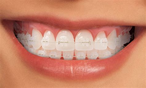 que es mejor brackets metalicos o de ceramica|Brackets De Cerámica O Brackets Metálicos: Diferencias ¿Cuál .